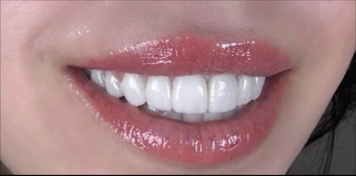 After dental treatment