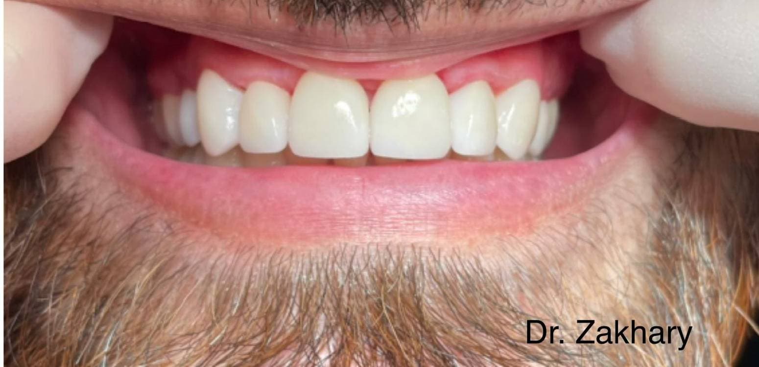 After dental treatment