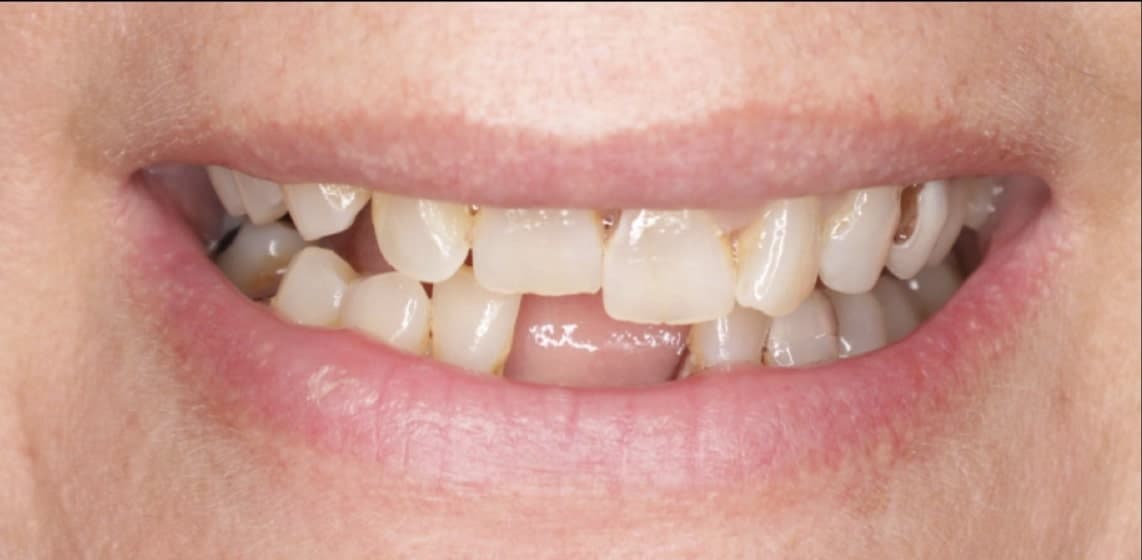 Before dental treatment