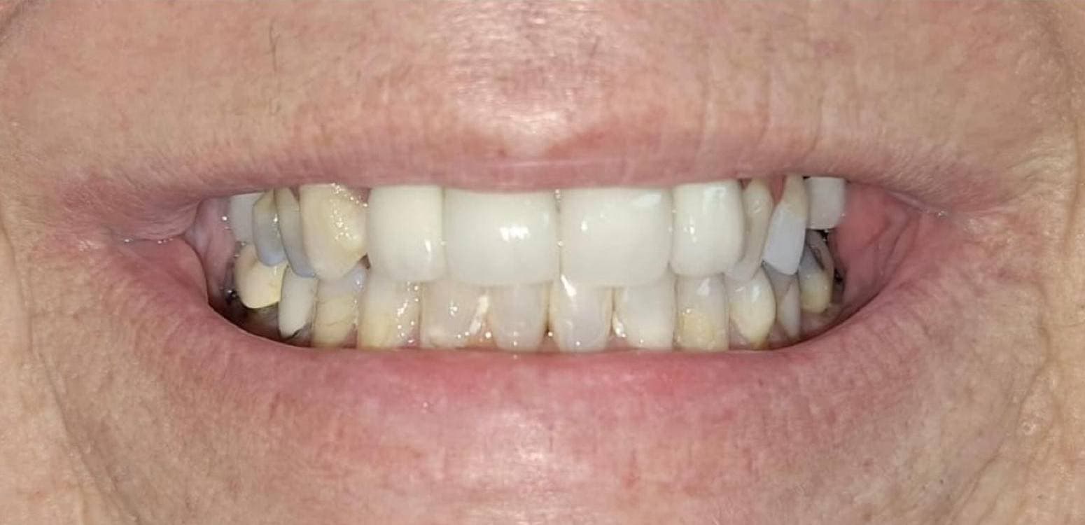 Before dental treatment