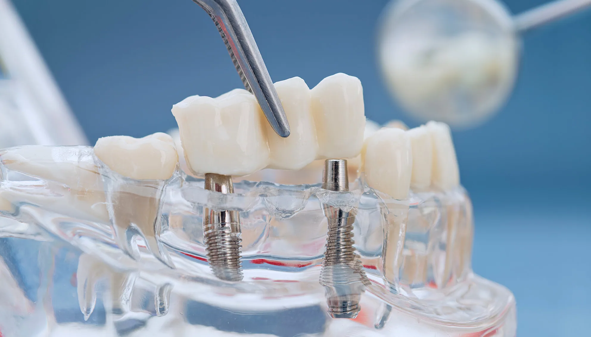 Dental bridges