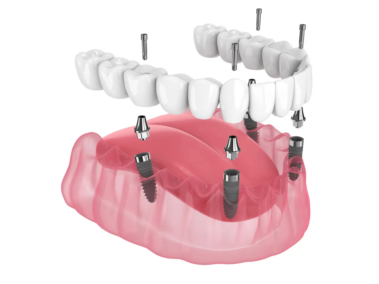 All-on-4 dental implants