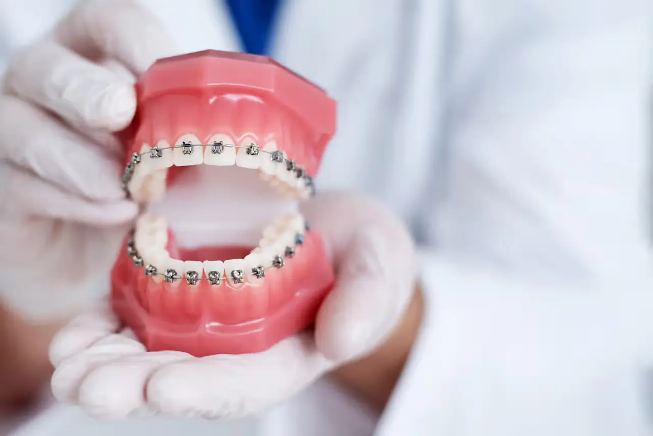 Traditional braces on a dental model