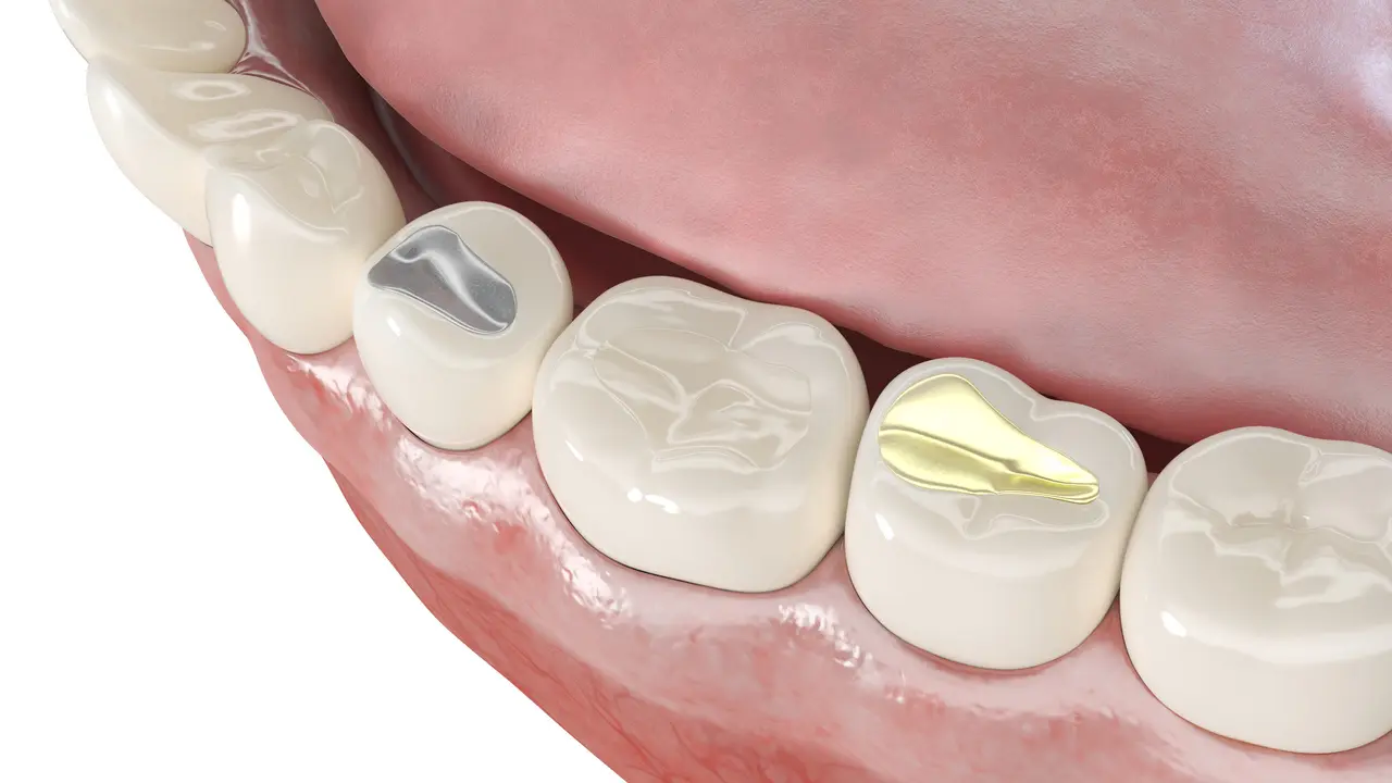 Dental fillings