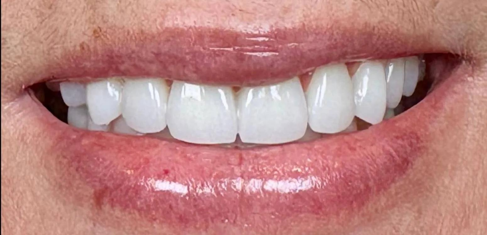 Smile transformation case 01, after treatment at Buena Park Dental Center