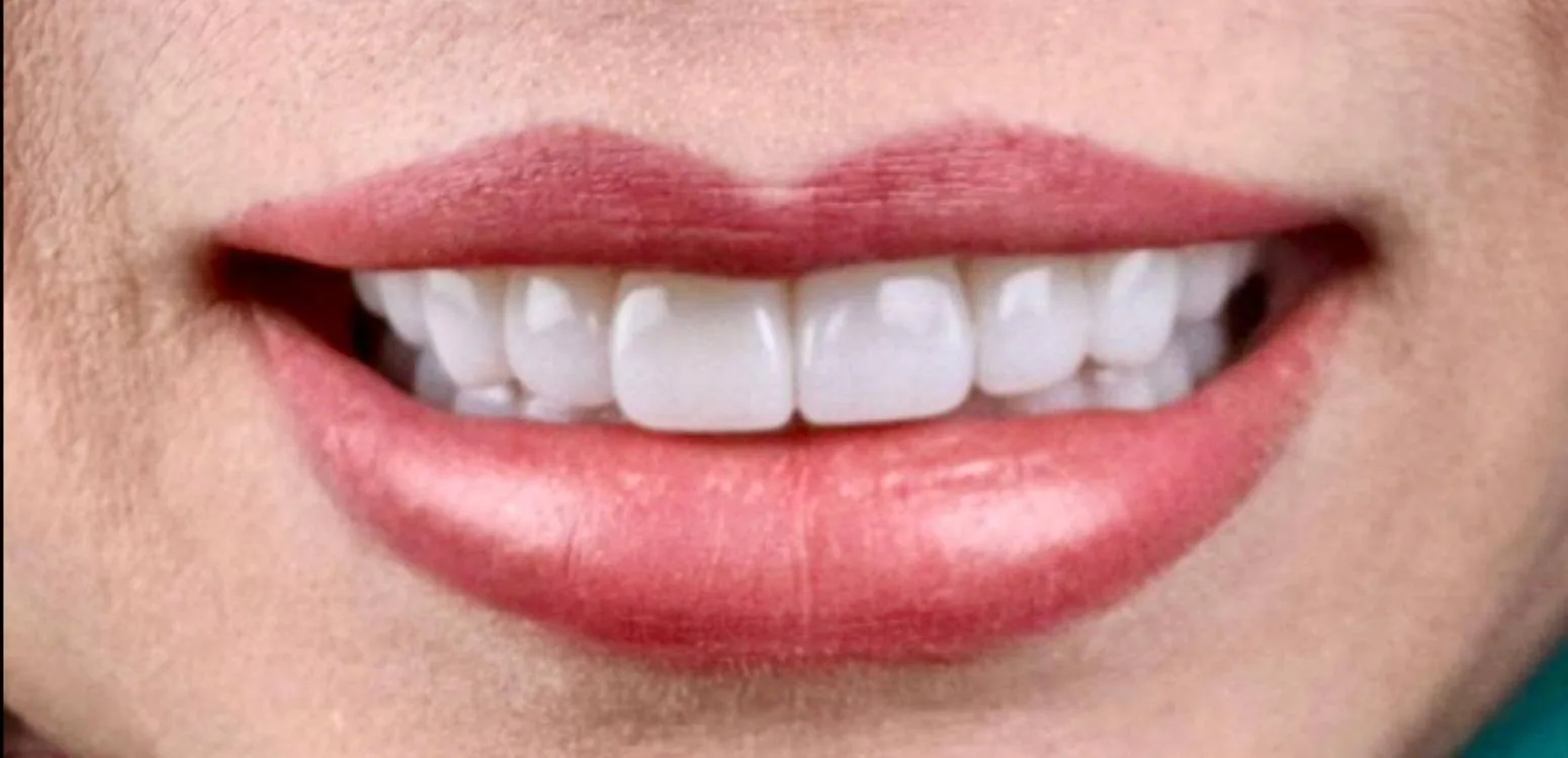 Smile transformation case 10, after treatment at Buena Park Dental Center