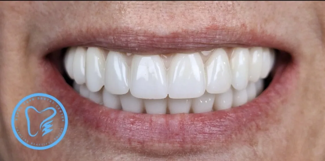 Smile transformation case 11, after treatment at Buena Park Dental Center