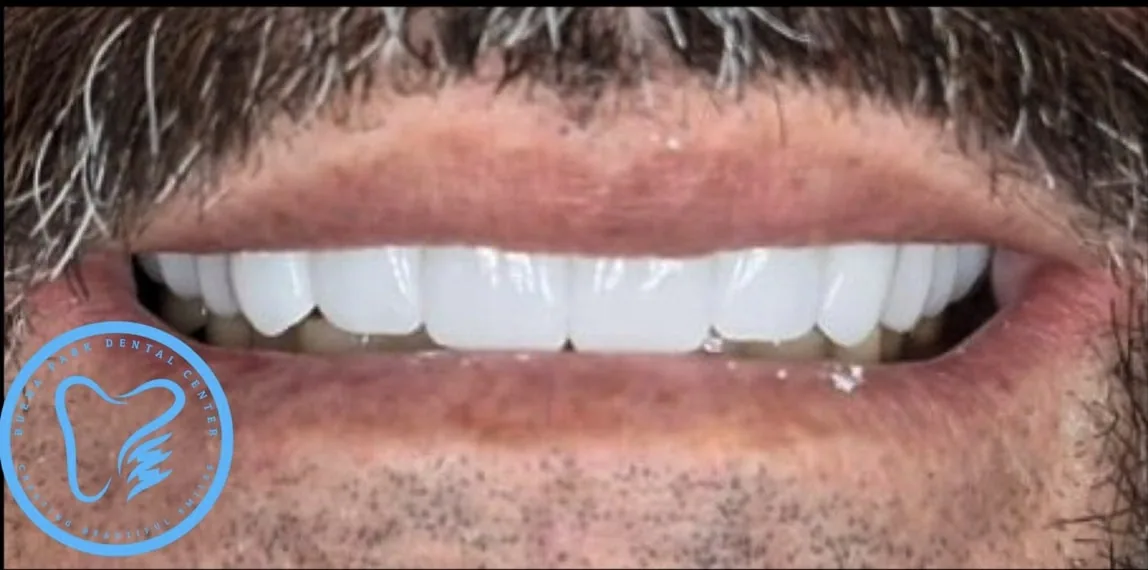 Smile transformation case 12, after treatment at Buena Park Dental Center