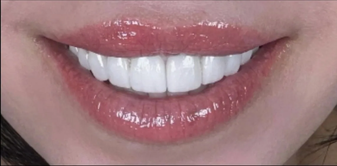 Smile transformation case 13, after treatment at Buena Park Dental Center
