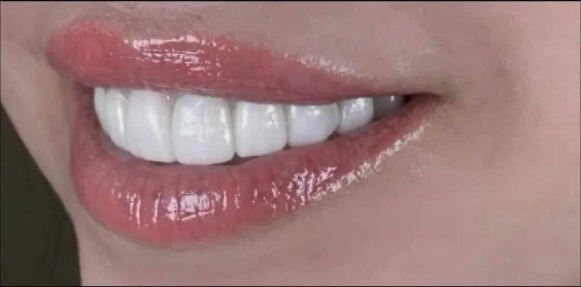 Smile transformation case 14, after treatment at Buena Park Dental Center
