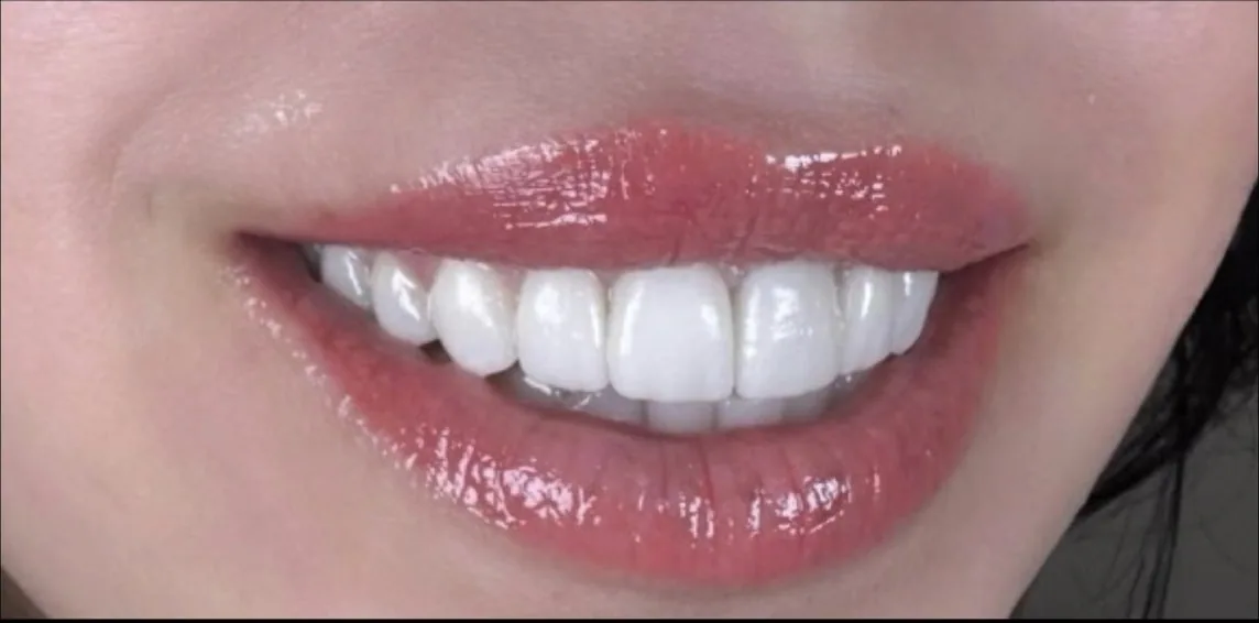 Smile transformation case 15, after treatment at Buena Park Dental Center