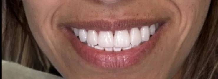 Smile transformation case 16, after treatment at Buena Park Dental Center