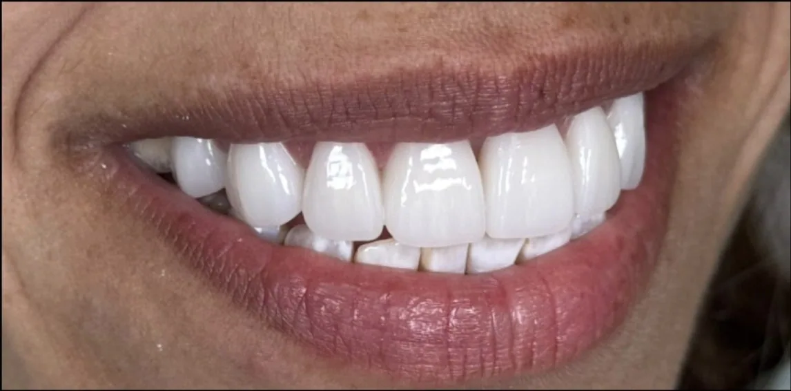 Smile transformation case 17, after treatment at Buena Park Dental Center
