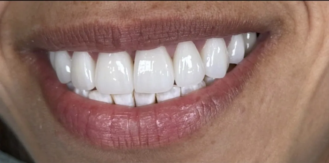 Smile transformation case 18, after treatment at Buena Park Dental Center
