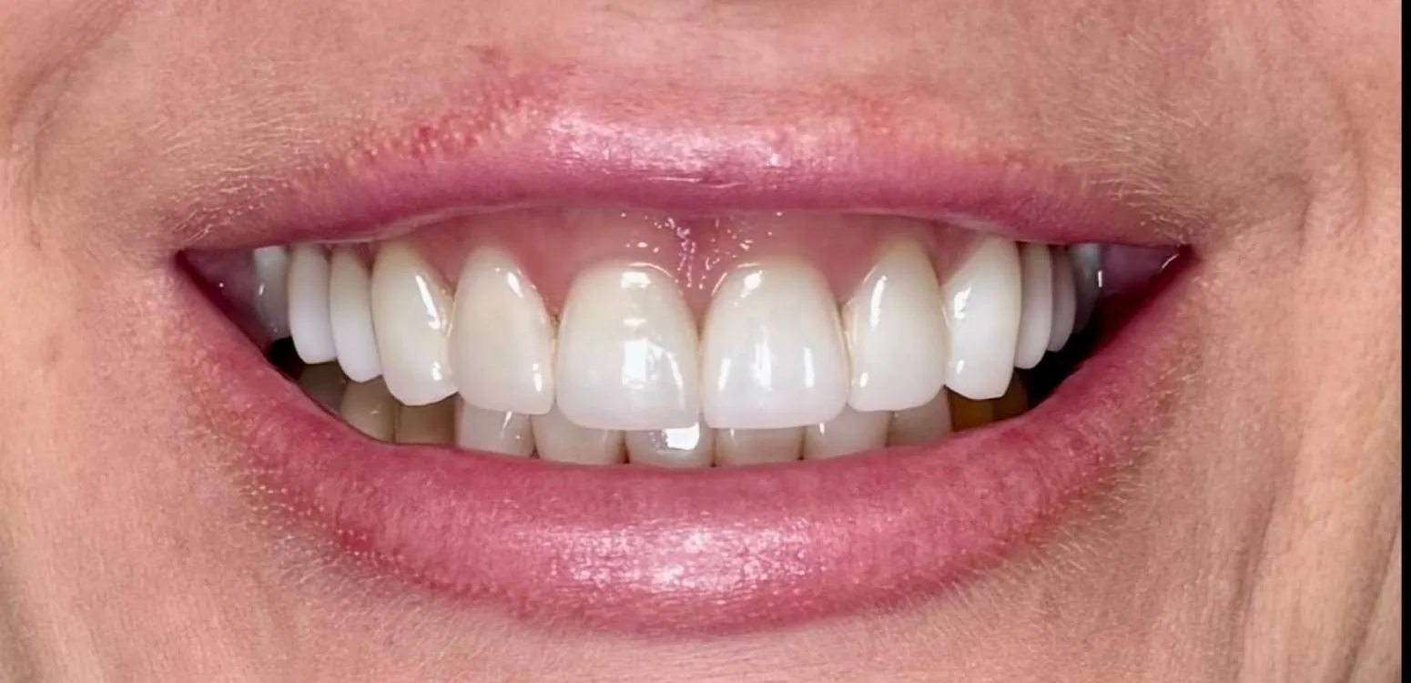 Smile transformation case 02, after treatment at Buena Park Dental Center