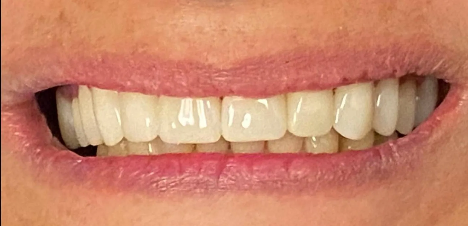 Smile transformation case 03, after treatment at Buena Park Dental Center