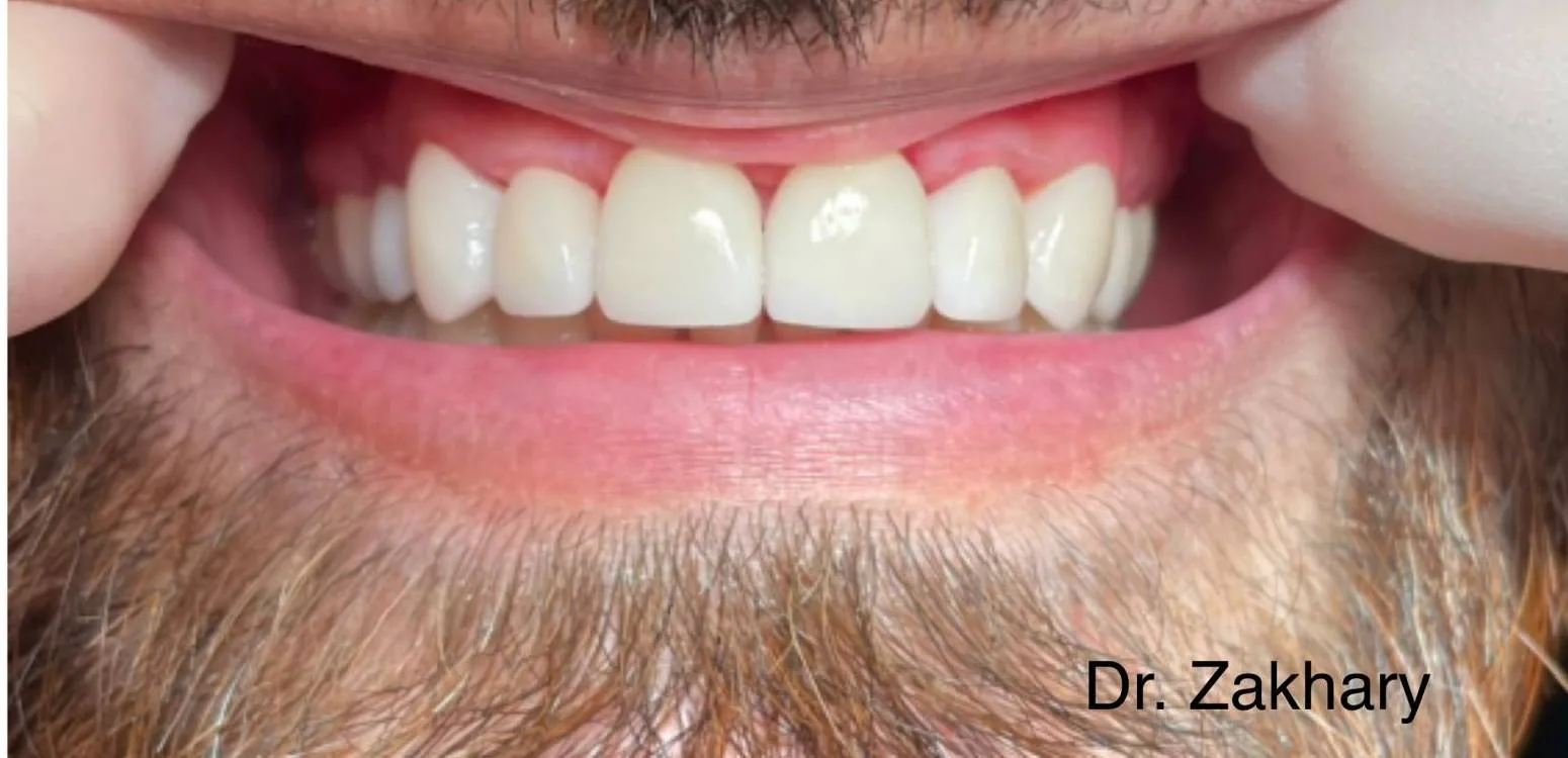 Smile transformation case 04, after treatment at Buena Park Dental Center