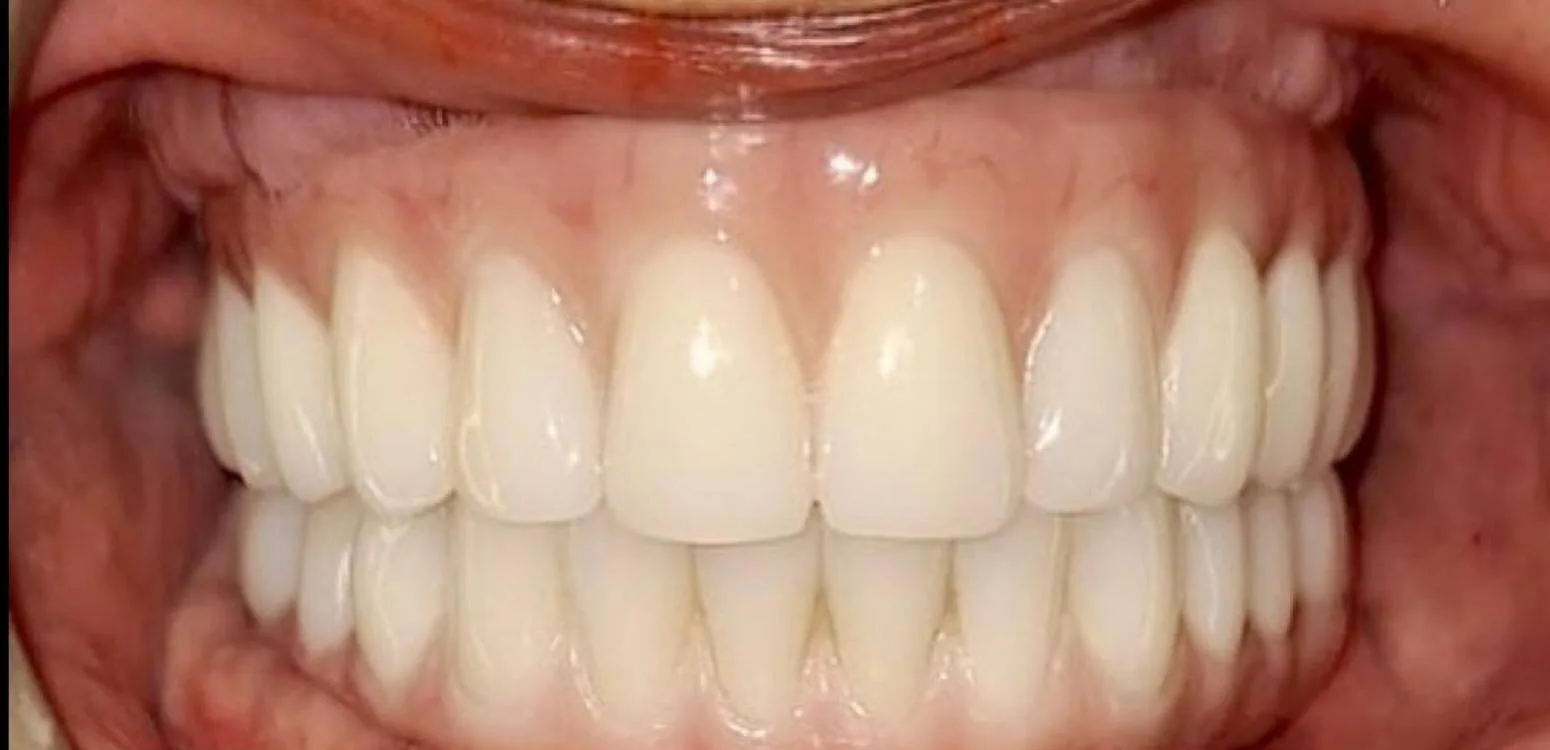 Smile transformation case 05, after treatment at Buena Park Dental Center