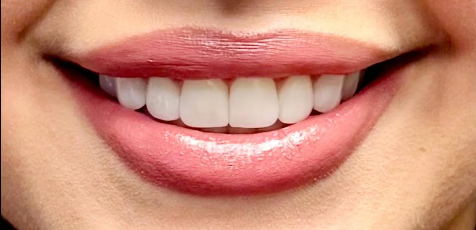 Smile transformation case 06, after treatment at Buena Park Dental Center