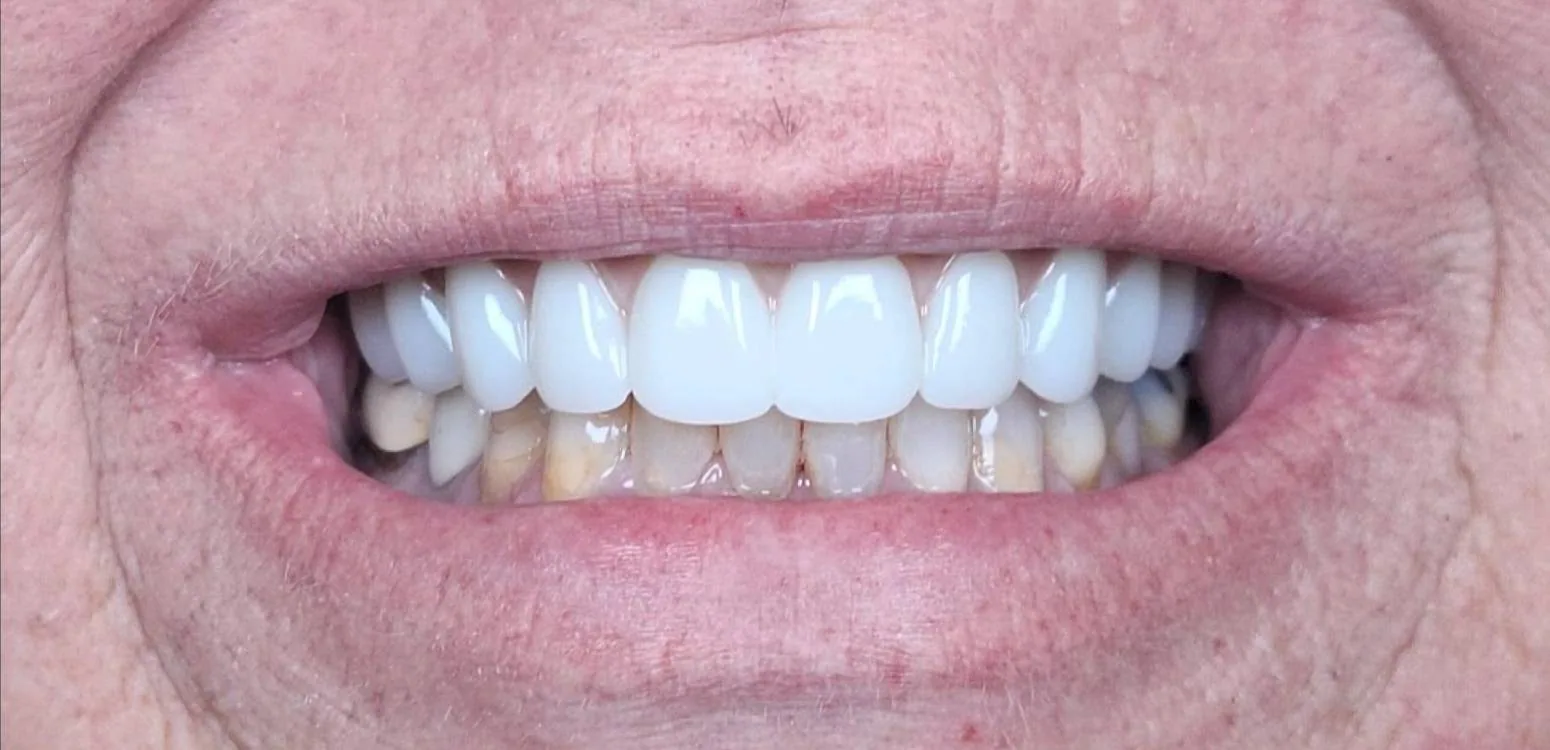 Smile transformation case 09, after treatment at Buena Park Dental Center