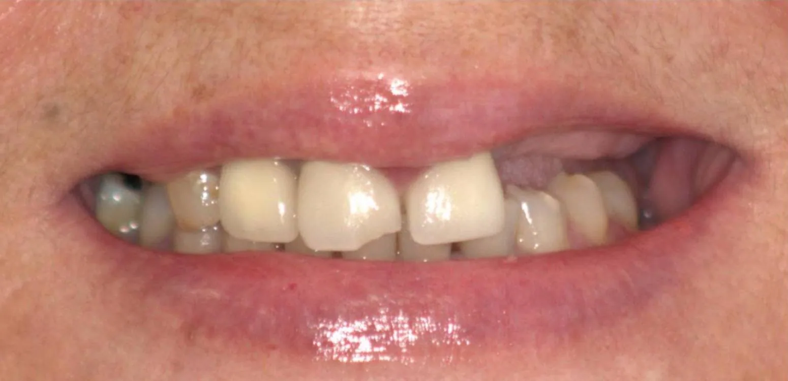 Smile transformation case 01, before treatment at Buena Park Dental Center