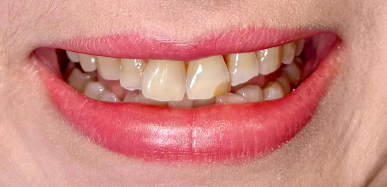 Smile transformation case 10, before treatment at Buena Park Dental Center