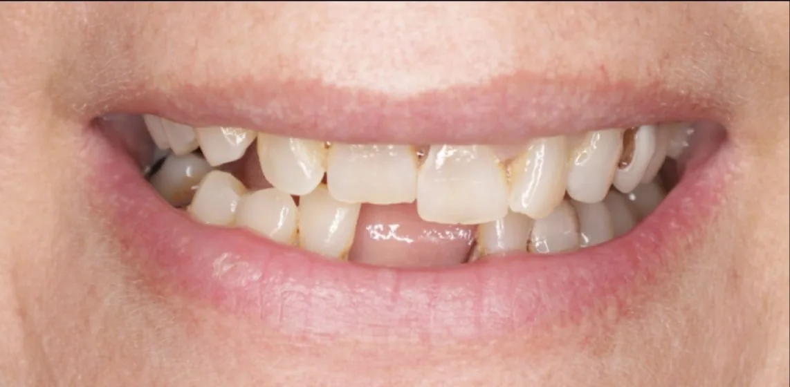Smile transformation case 11, before treatment at Buena Park Dental Center
