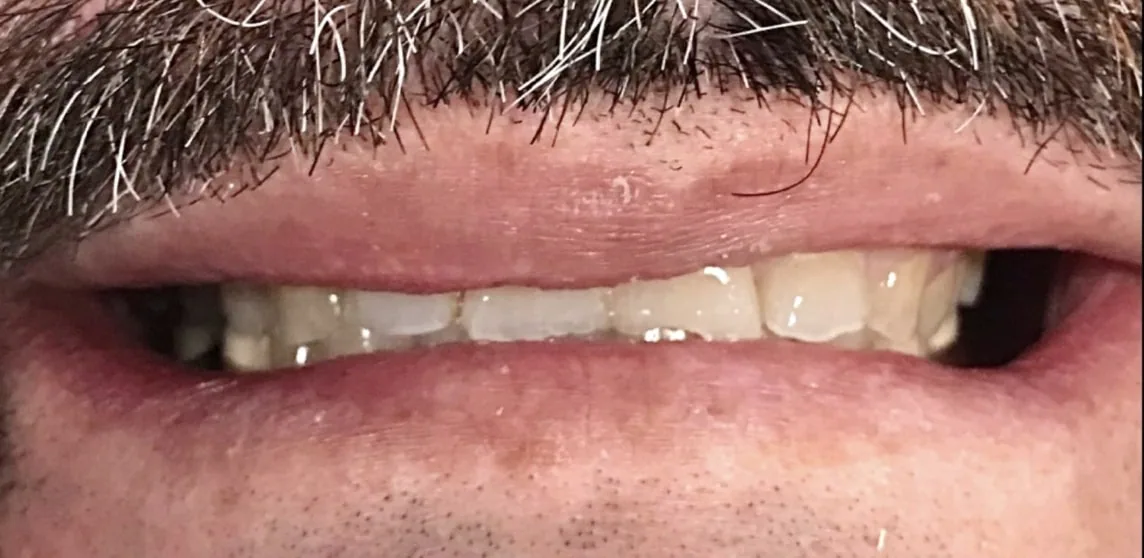 Smile transformation case 12, before treatment at Buena Park Dental Center