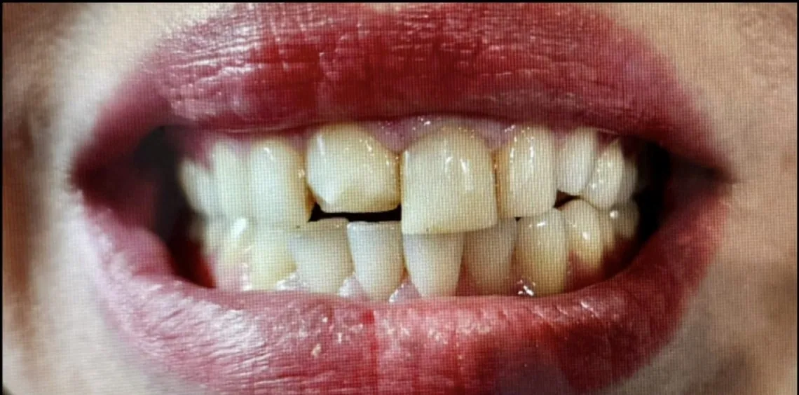 Smile transformation case 13, before treatment at Buena Park Dental Center
