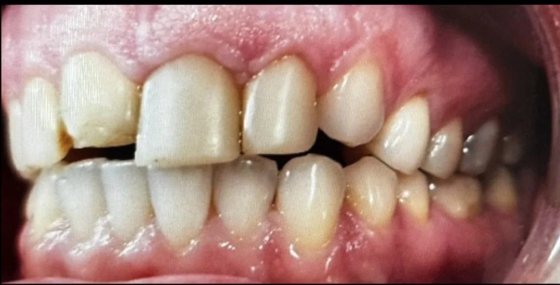Smile transformation case 14, before treatment at Buena Park Dental Center