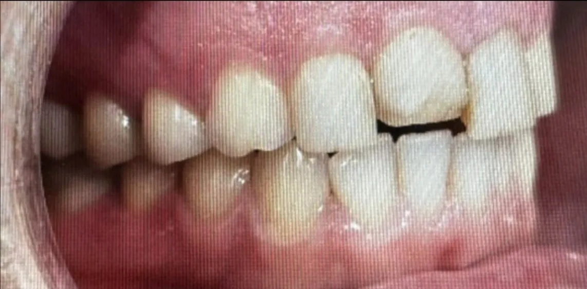 Smile transformation case 15, before treatment at Buena Park Dental Center