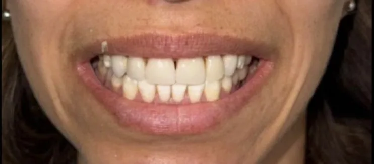 Smile transformation case 16, before treatment at Buena Park Dental Center