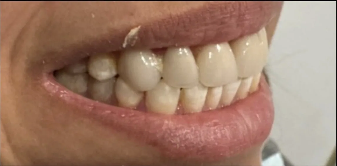 Smile transformation case 17, before treatment at Buena Park Dental Center