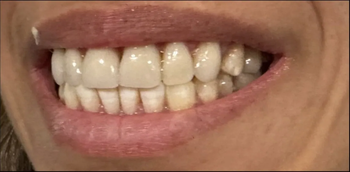 Smile transformation case 18, before treatment at Buena Park Dental Center