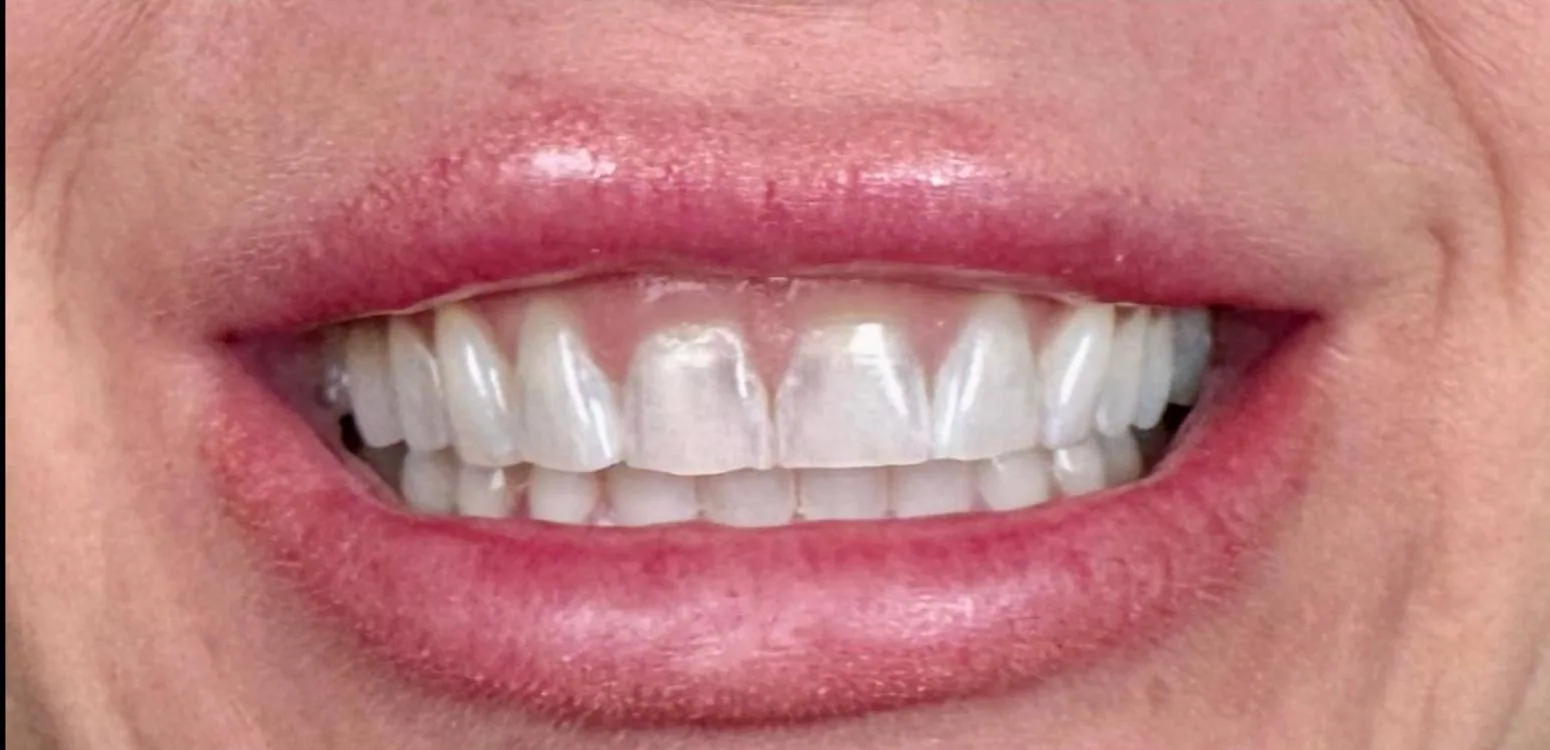 Smile transformation case 02, before treatment at Buena Park Dental Center