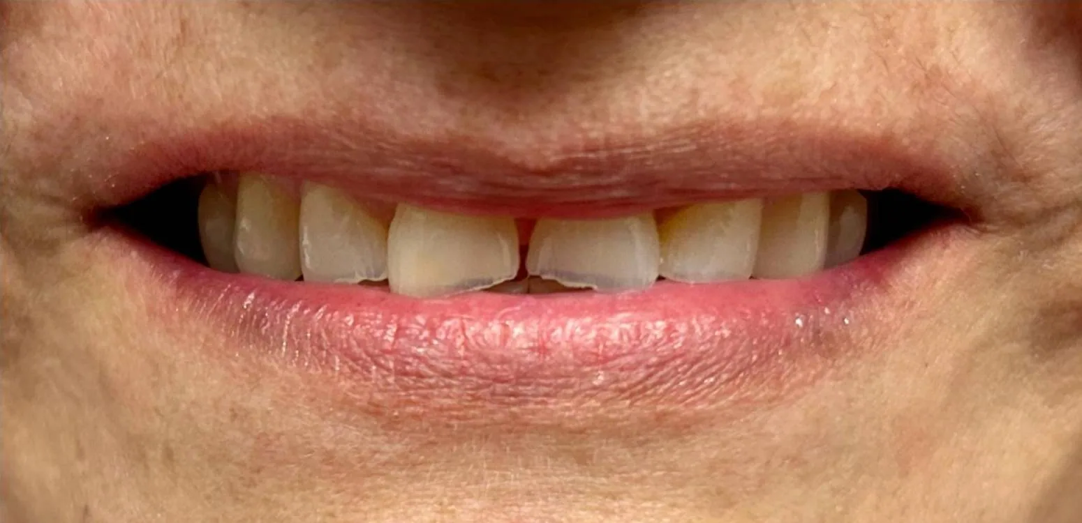 Smile transformation case 03, before treatment at Buena Park Dental Center