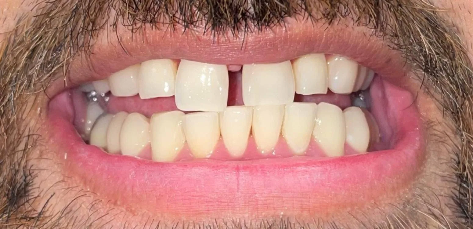 Smile transformation case 04, before treatment at Buena Park Dental Center