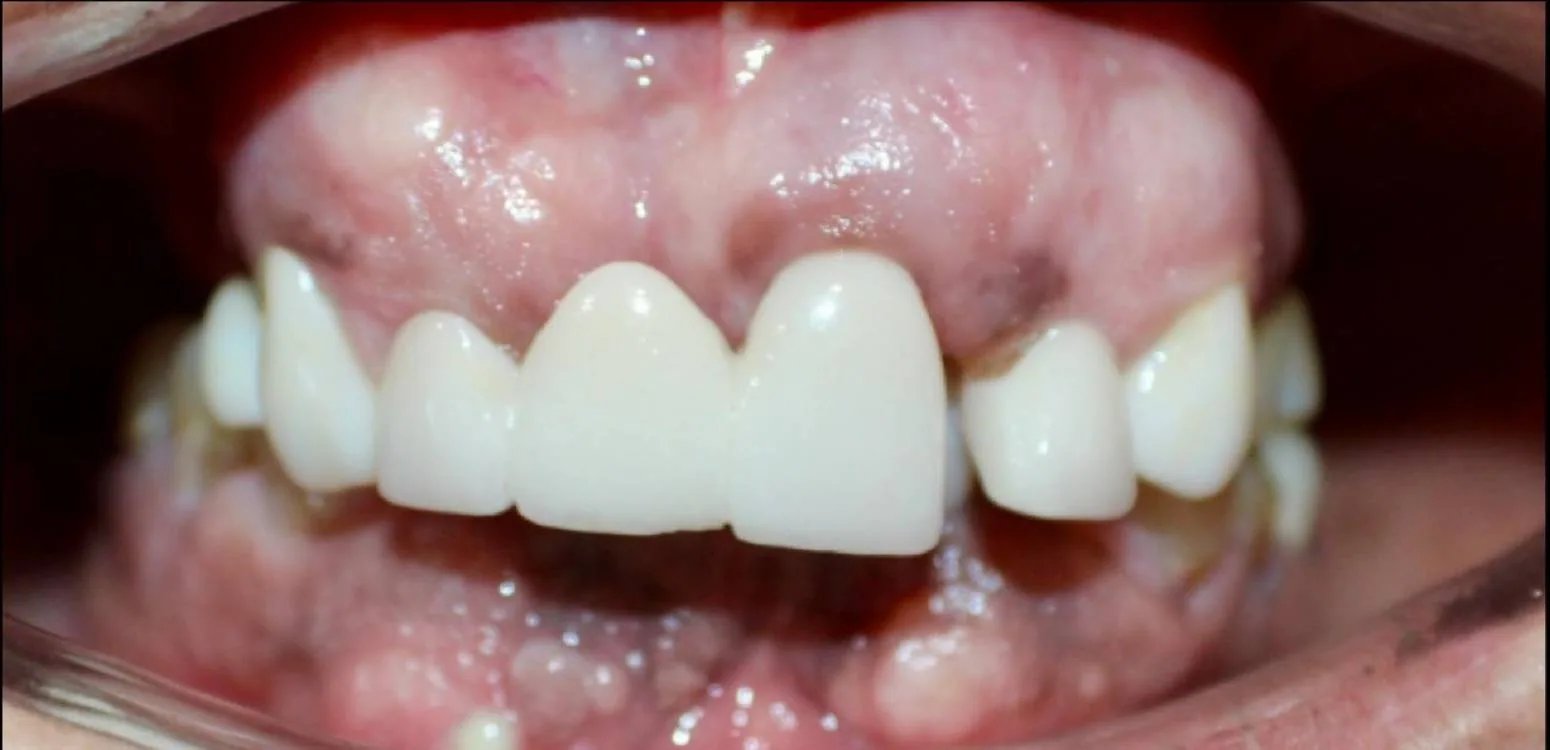 Smile transformation case 05, before treatment at Buena Park Dental Center