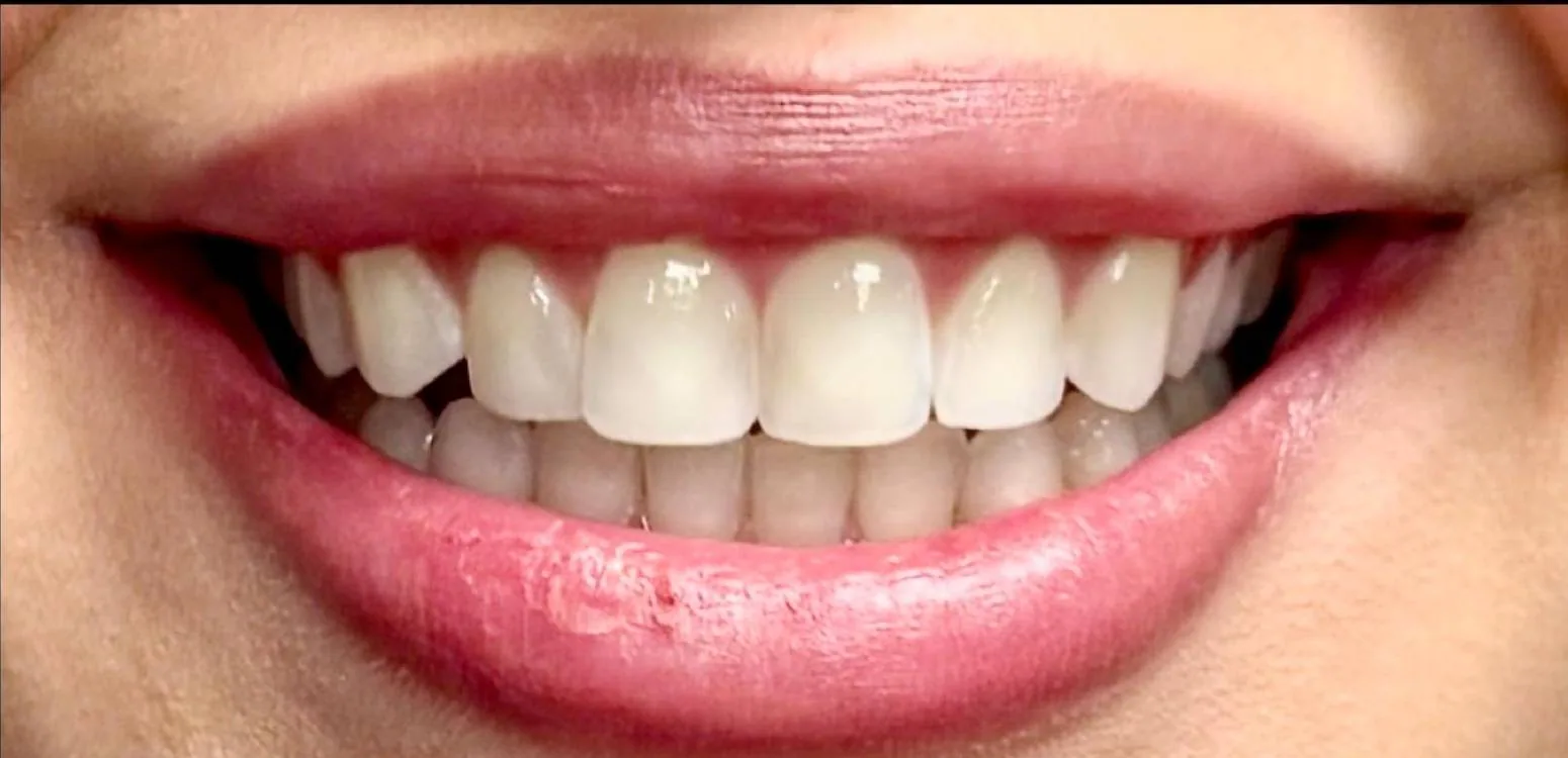 Smile transformation case 06, before treatment at Buena Park Dental Center