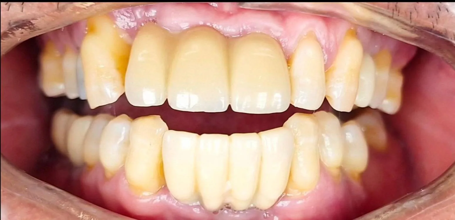 Smile transformation case 07, before treatment at Buena Park Dental Center