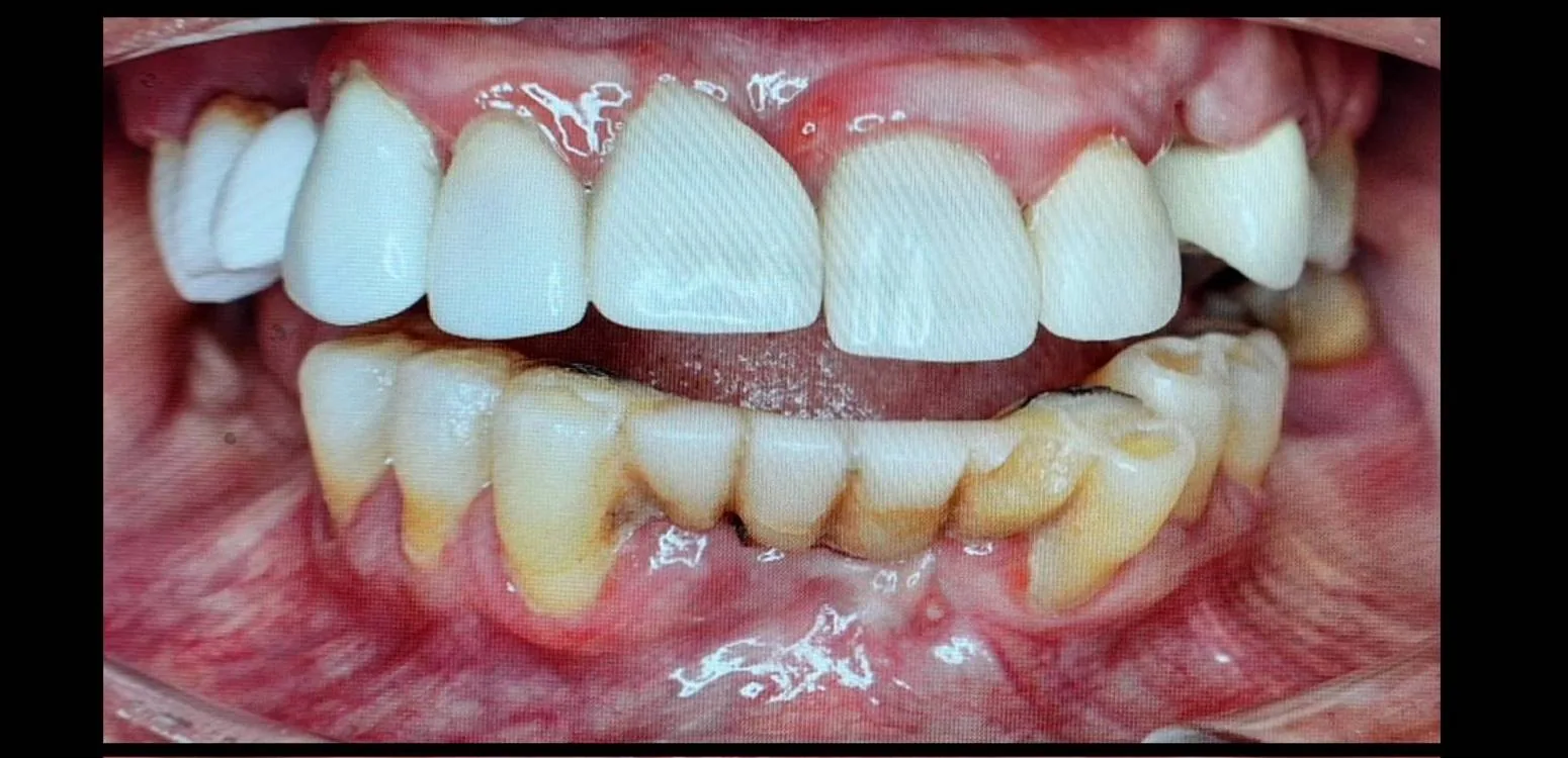 Smile transformation case 08, before treatment at Buena Park Dental Center
