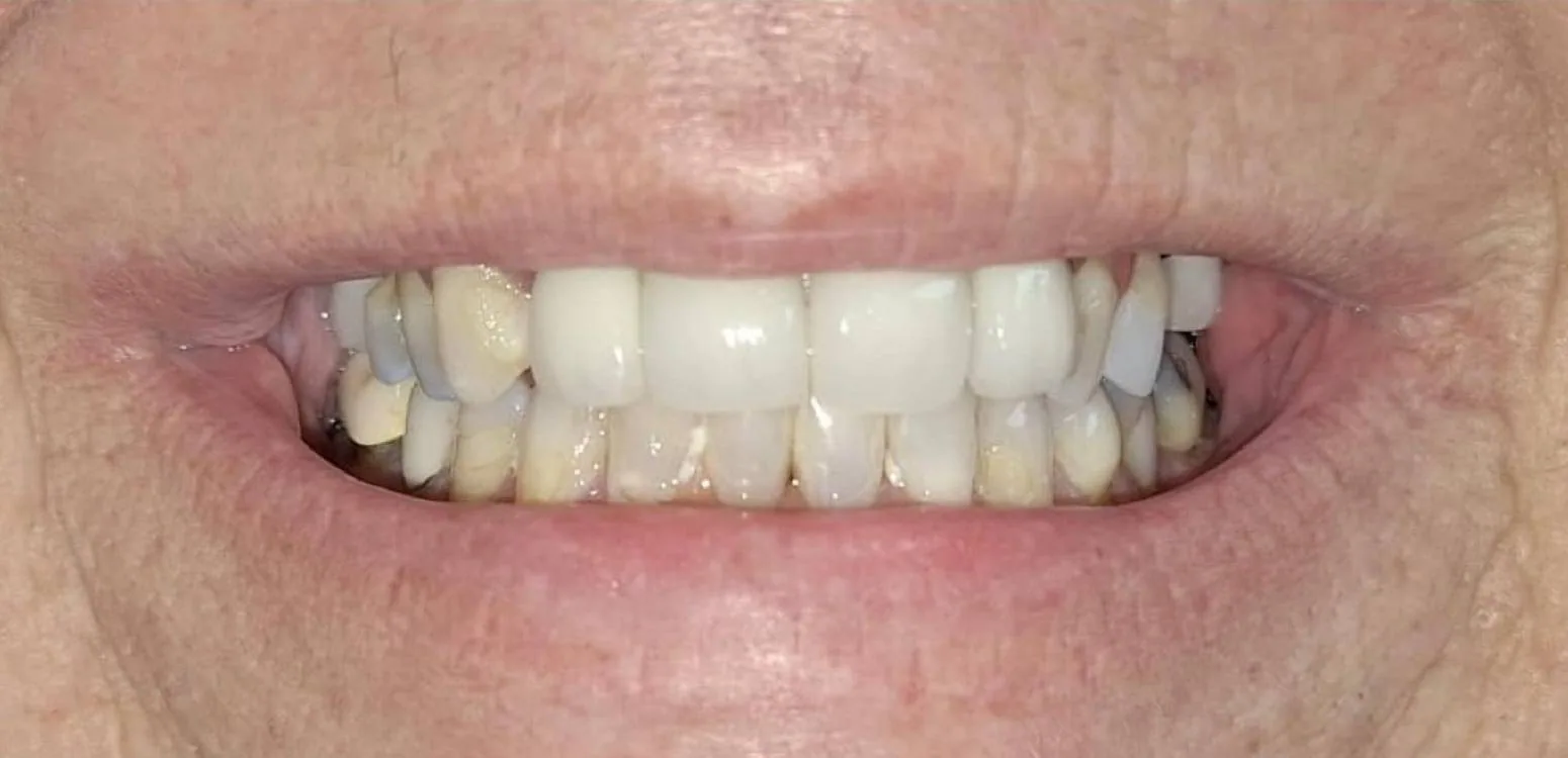 Smile transformation case 09, before treatment at Buena Park Dental Center